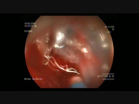 Disección submucosa endoscópica de tumor rectosigmoideo