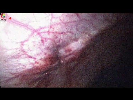 Dispositivo de cierre fascial Nasr para sutura múltiple para puertos de gran tamaño