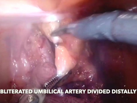 Resección abdominoperineal asistida por robot – TME extendida