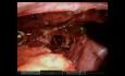 Esofagectomía transhiatal robótica (SESC 2021)