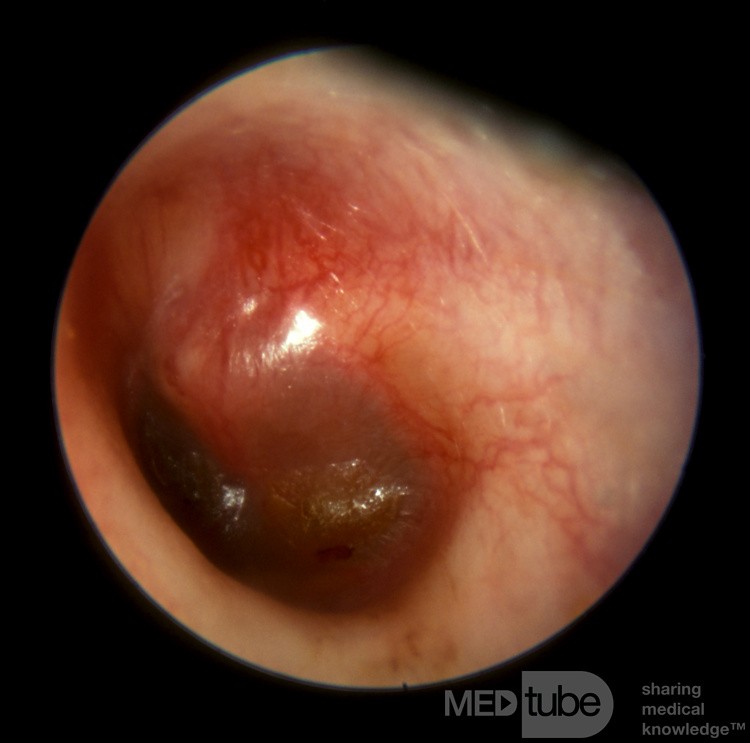 Otitis media aguda