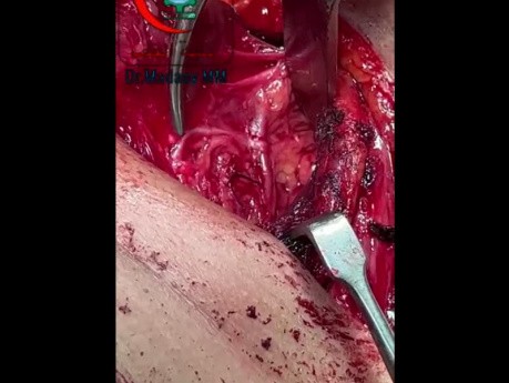 Ramificación extralaríngea del nervio laríngeo recurrente