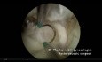 Miomectomía histeroscópica desafíante con resecare