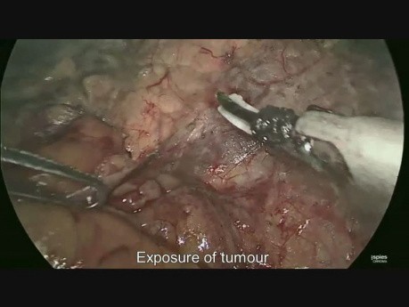 Extirpación laparoscópica de un feocromocitoma
