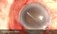 Glaucoma maligno espontáneo durante la facotrabeculectomía