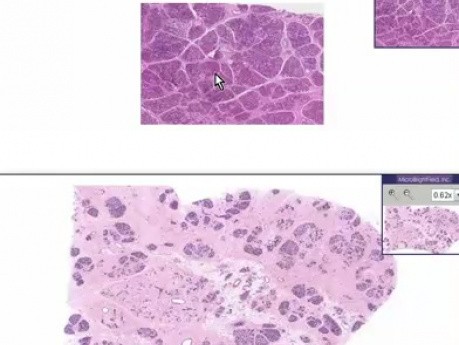 Hiperplasia durante la lactancia - histopatología - mama