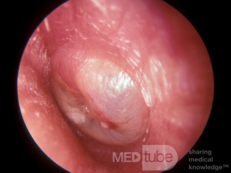 Otitis media aguda grave que se drenó espontáneamente una hora después