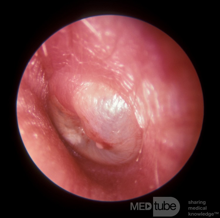 Otitis media aguda grave que se drenó espontáneamente una hora después