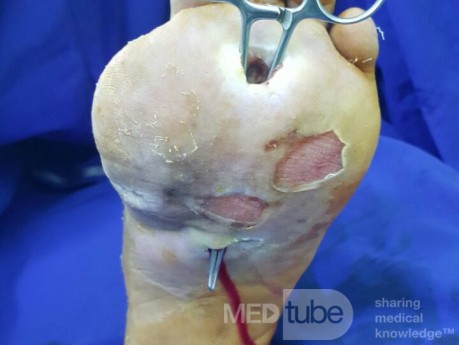 Úlcera del pie diabético con infección
