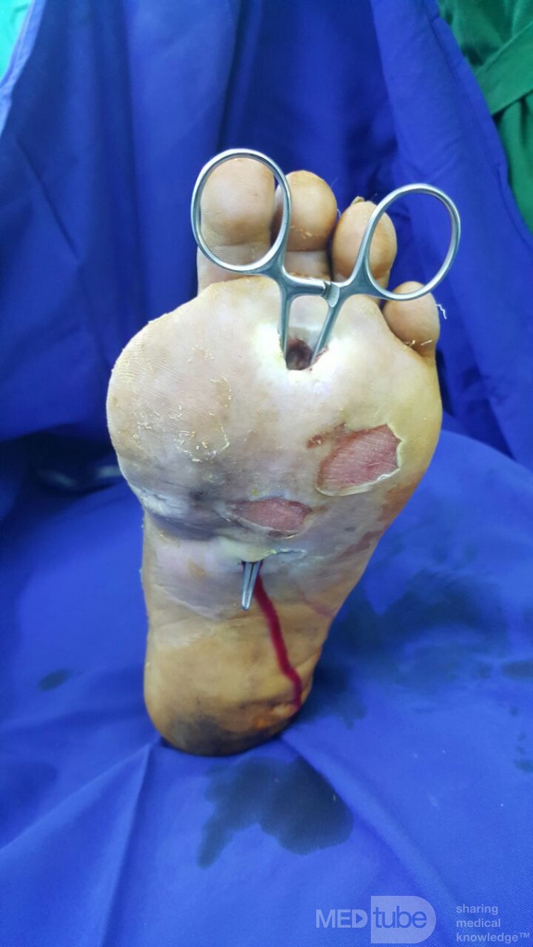 Úlcera del pie diabético con infección