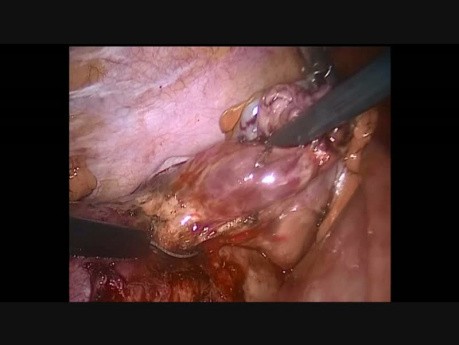 Laparoscopia durante el embarazo