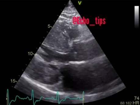 5. Caso de ecocardiografía - ¿Qué se ve?