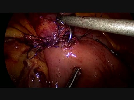 Bypass gástrico con anastomosis yeyunal cosido a mano 