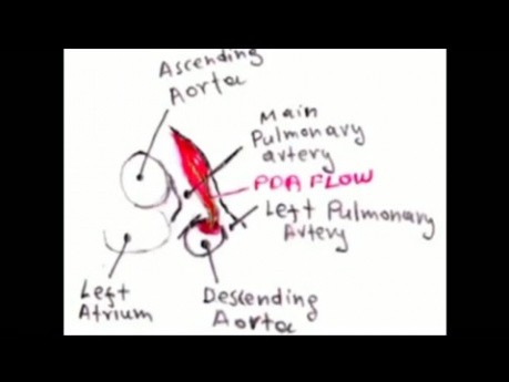 Conducto Arterioso Persistente (CAP) - ECG, Ecocardiografía y Tratamiento