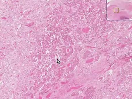 Infarto parcial - histopatología - glandula pineal