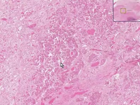 Infarto parcial - histopatología - glandula pineal