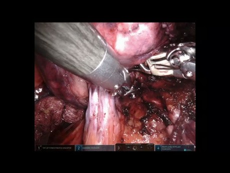 Segmentectomía anatómica - cirugía de pulmón