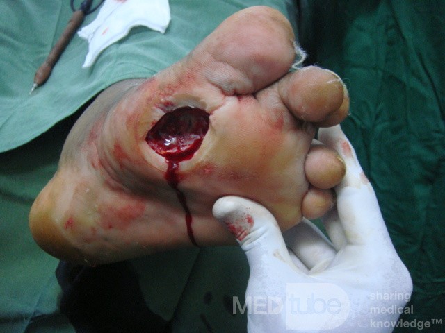Úlcera del pie diabético - neuropatía - asociada a osteomielitis