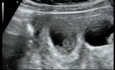Reducción transvaginal del feto de un embarazo cuádruple 