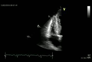 Amiloidosis cardiaca hipertrofia del ventriculo derecho