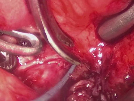 Reconstrucción laparoscópica del cuello vesical mediante injerto de mucosa bucal