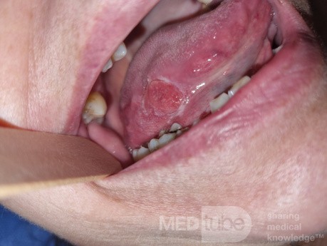 Carcinoma espinocelular