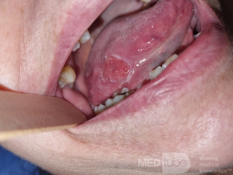 Carcinoma espinocelular