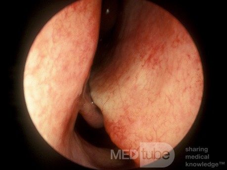 Tabique nasal gravemente desviado