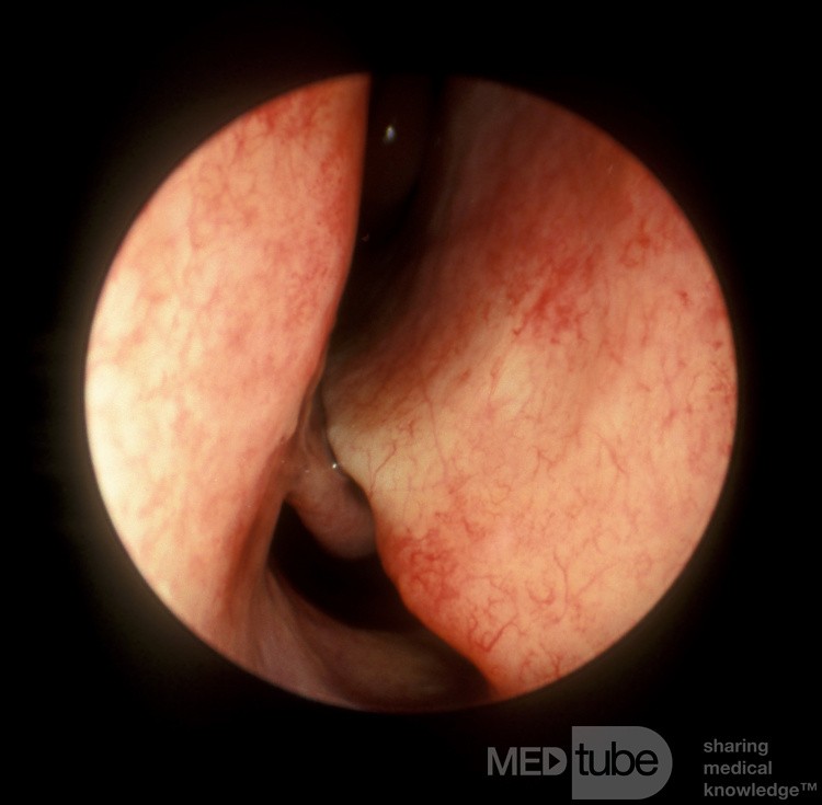 Tabique nasal gravemente desviado