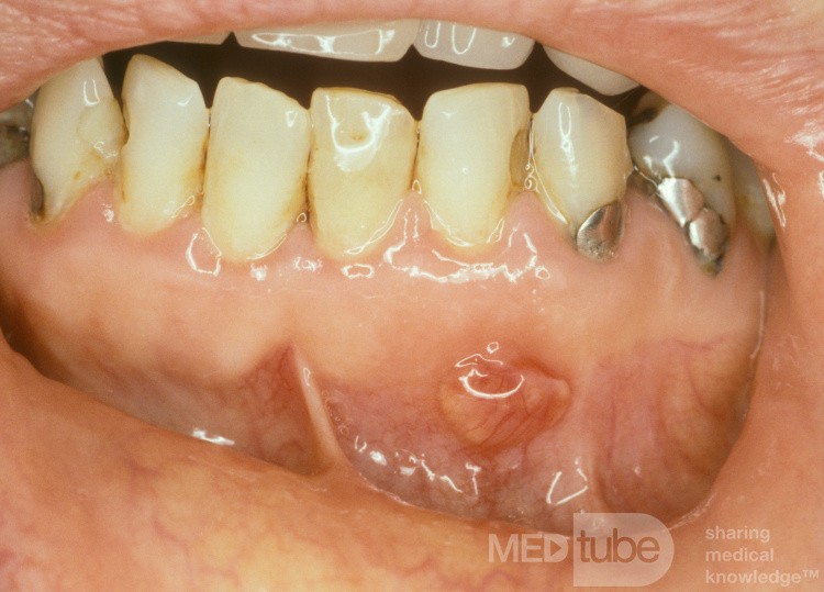 Absceso y granuloma de la raíz