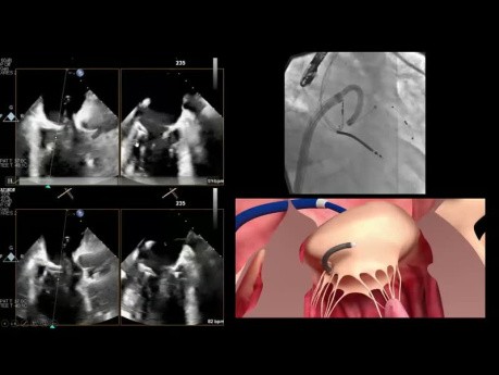 Por qué el reemplazo de válvula mitral transcatéter (TMVR) aún no es un implante de válvula aórtica transcatéter (TAVI)?