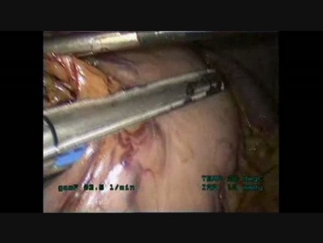 Esofagectomía laparoscópica / toracoscópica