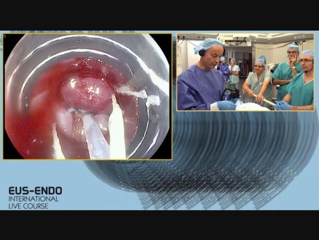 Resección endoscópica - Discusión: ¿DSE o RME?