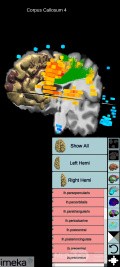 Planificación quirúrgica con neuronavegador en paciente con lesión de masa intracraneal. Glioma de alto grado.