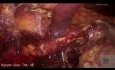 Hemicolectomía derecha laparoscópica para diverticulitis perforada