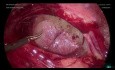 Enterólisis laparoscópica Tina Hydrosalpinx