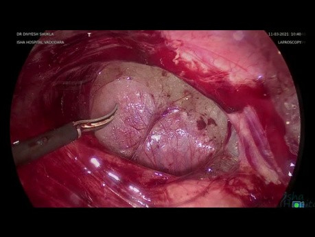 Enterólisis laparoscópica Tina Hydrosalpinx