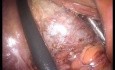 Colecistectomía laparoendoscópica de sitio único (LESS) con histerectomía supracervical concomitante sin anestesia general