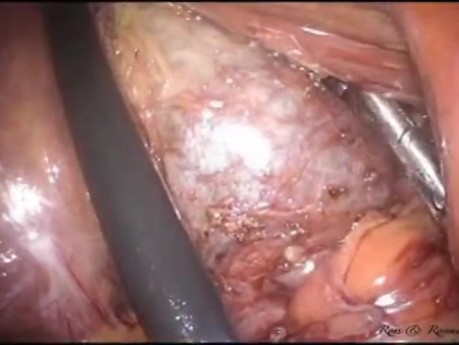 Colecistectomía laparoendoscópica de sitio único (LESS) con histerectomía supracervical concomitante sin anestesia general
