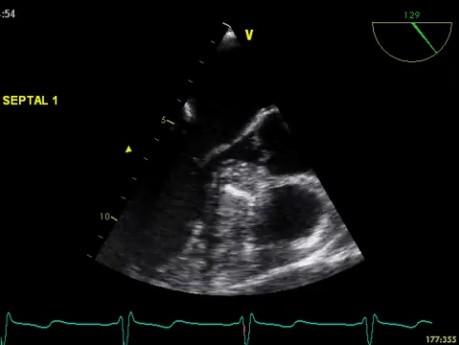 Tratamiento de la miocardiopatía hipertrófica obstructiva - ablación septal con alcohol.