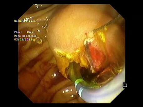 Tumor papilar expuesto