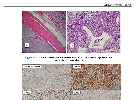 Coexistencia de tumor del estroma gastrointestinal gástrico y colitis ulcerosa en paciente con dispepsia y rectorragia: reporte de un caso