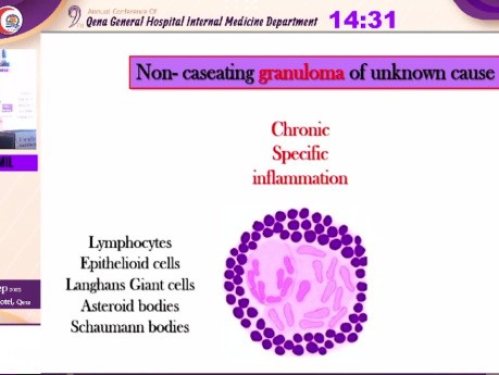 Sarcoidosis