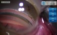 Implante de microstent para glaucoma en el cuadrante superior