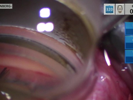 Implante de microstent para glaucoma en el cuadrante superior