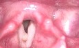 Quiste de la mucosa de las cuerdas vocales