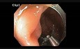 Colonoscopia - RME de ciego en un paciente con antecedente de cirugía de hígado y colon