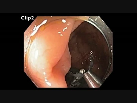 Colonoscopia - RME de ciego en un paciente con antecedente de cirugía de hígado y colon