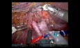 Hepatectomía izquierda ampliada robótica y reconstrucción biliar para el tumor de Klatskin