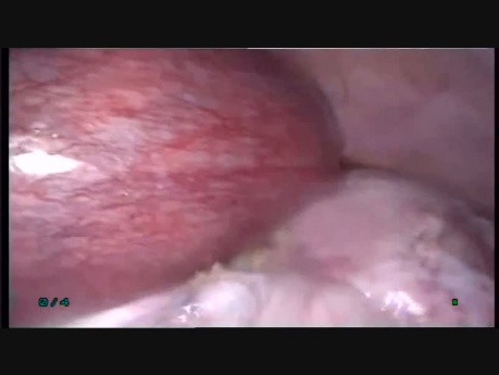 Extirpación laparoscópica de un quiste ovárico grande en una paciente en la semana 18. de embarazo